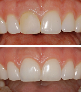 Dental Implant Repair & Renewal